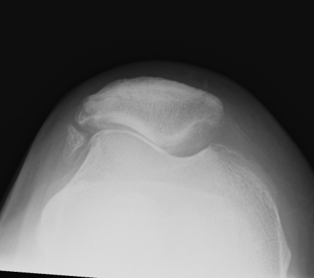 Patella Excessive Lateral Tension